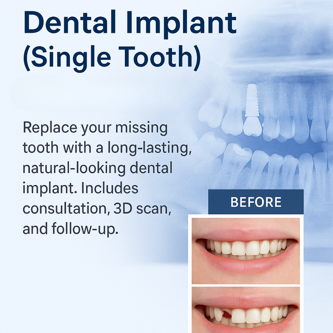 Dental Implants